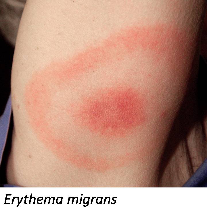 erythema3.jpg